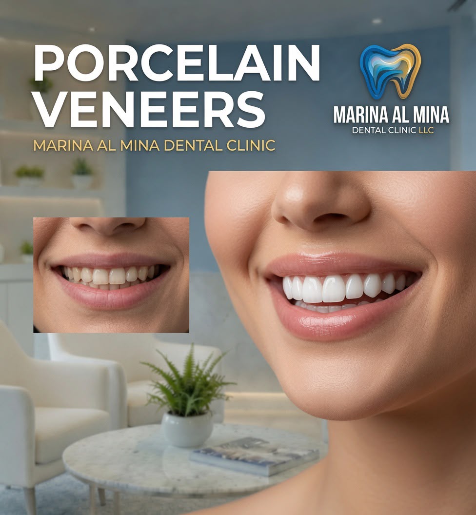 Veneers